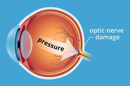 January is glaucoma awareness month! Did you know that glaucoma is one of the leading causes of blindness in Canada? Glaucoma is the build up of pressure caused by a backup of fluid in the eye. This pressure can lead to loss of nerve tissue that results in gradual irreversible vision loss and blindness of not detected and treated early. Age, family history, medical conditions, physical injury and severe trauma to the eye are all risk factors. Regular eye exams are a great way of monitor your eye health! #eyepractice #rockwoodoptometrist #guelphoptometrist #rockwoodoptometry #guelphoptometry #glaucomaawareness