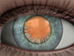 Description: Cortical cataract