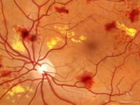 Description: Non-proliferative diabetic retinopathy