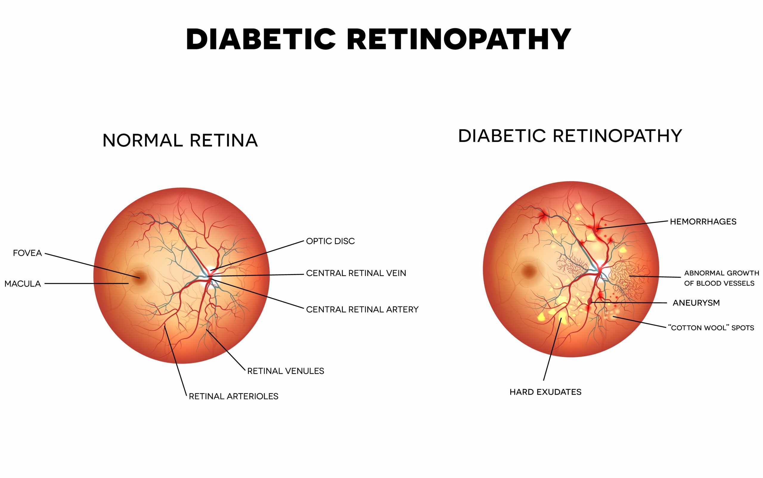 Diabetic Retinopathy Treatment