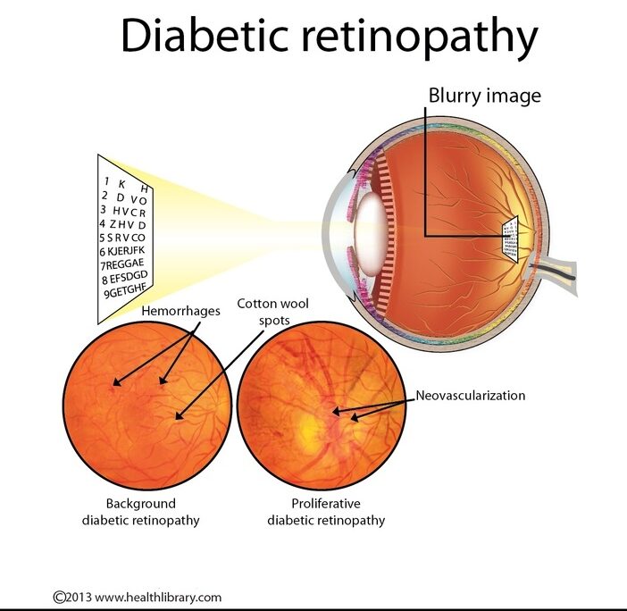 Diabetic Retinopathy